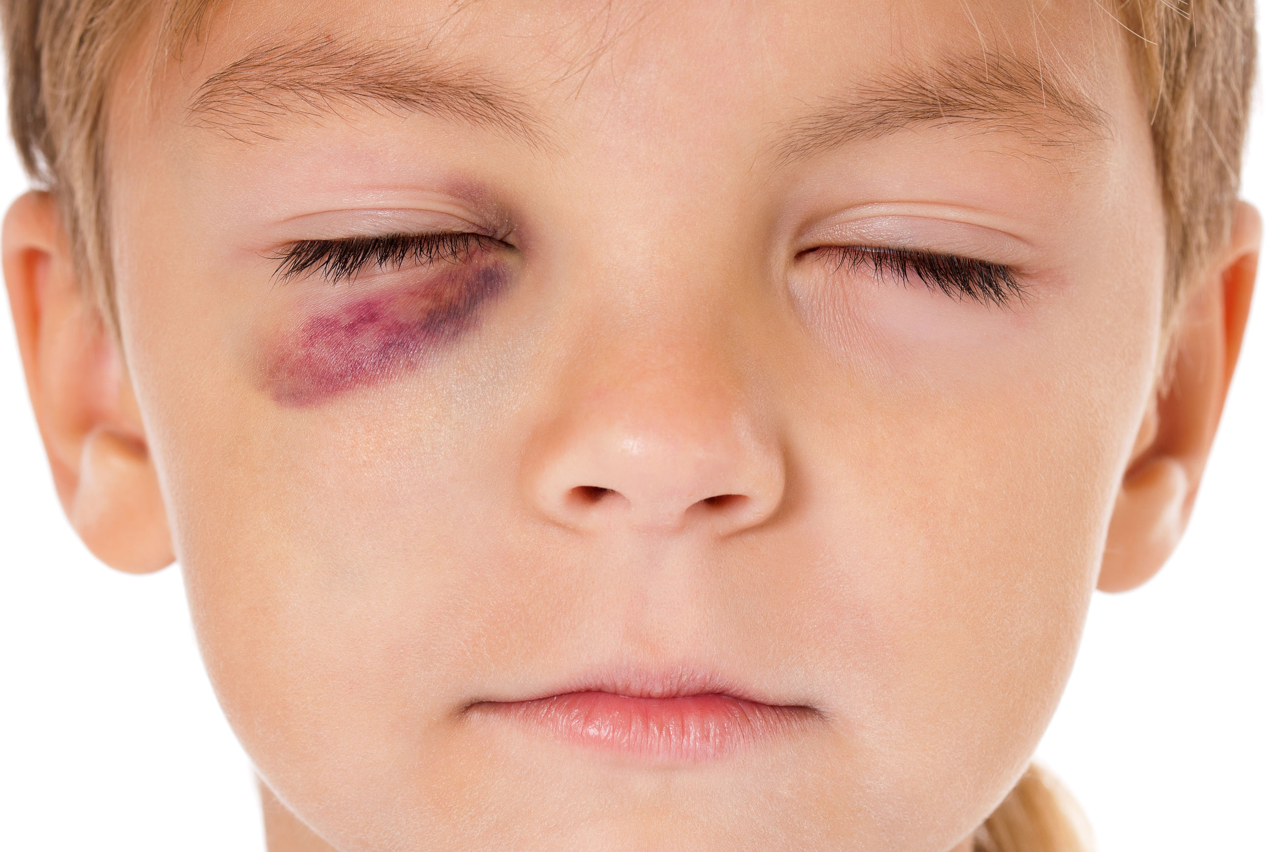 Acidentes oculares em crianças.